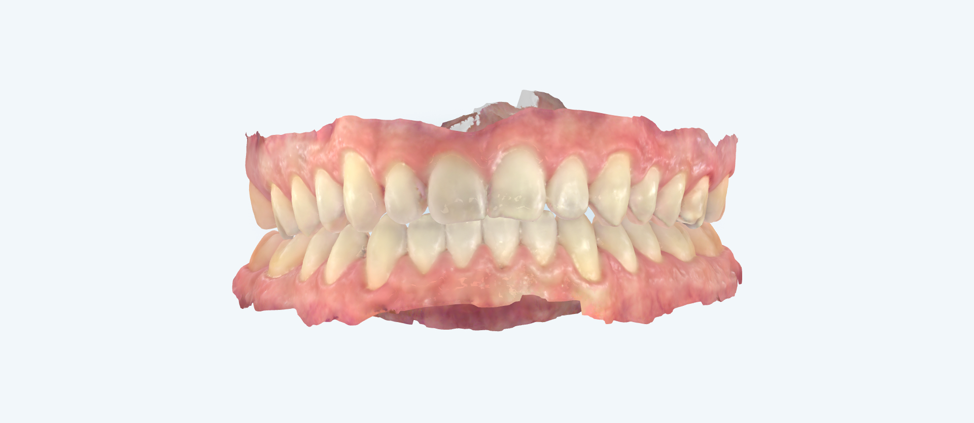 Underbite treatment comparison angled side view after